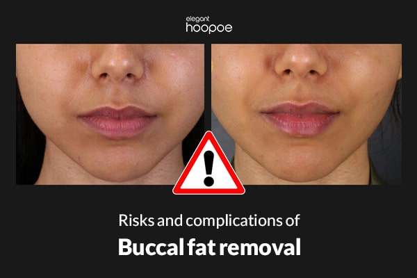 risks & complications of buccal fat removal