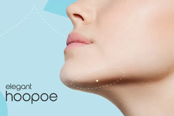 Kybella vs Laser Lipo results