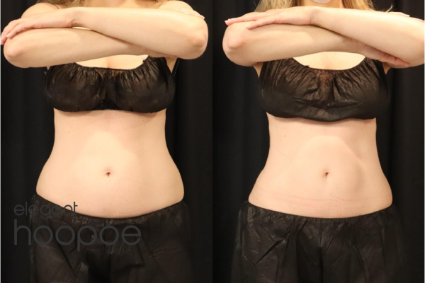 coolsculpting belly fat dubai before and after