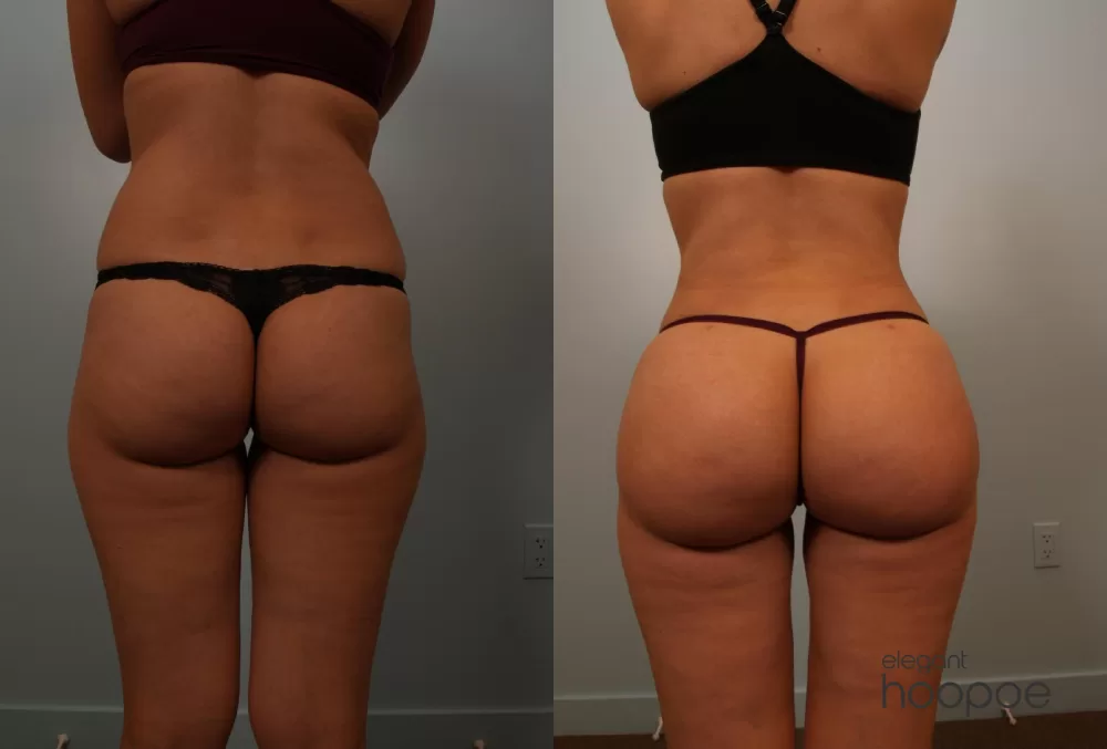 Butt lift result and review in dubai