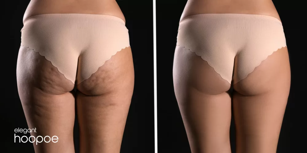 Cellulite treatment dubai before and after