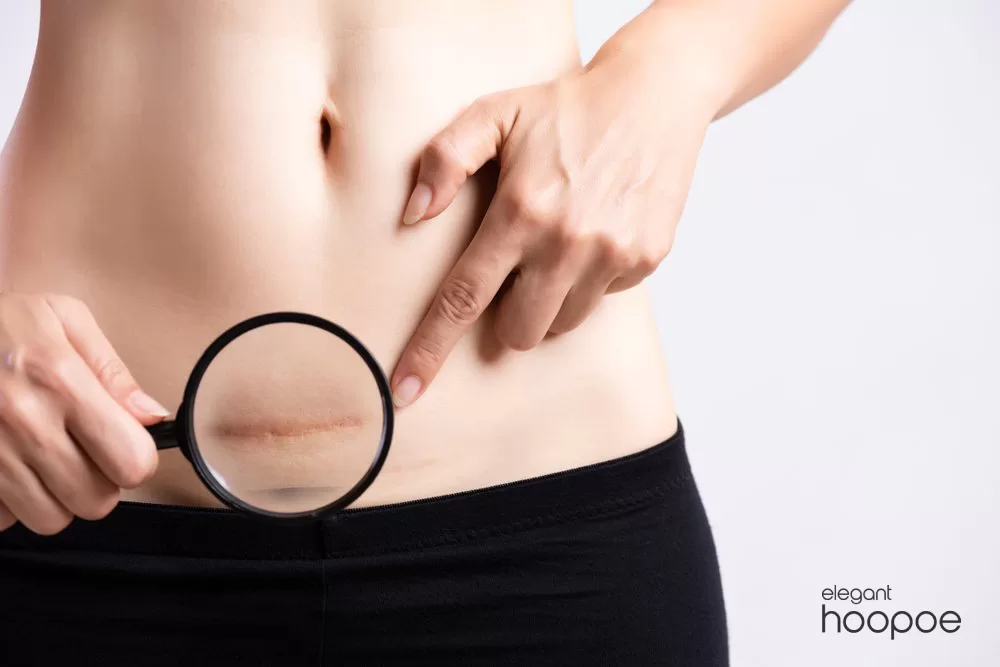 Does Liposuction leave scars?