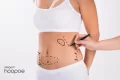 Liposuction Scars