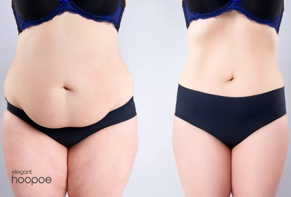 What is Micro Liposuction?