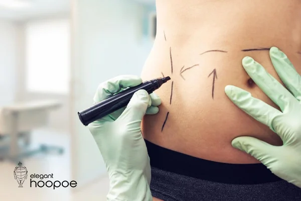 Which Areas Can Be Treated with Laser Lipo?