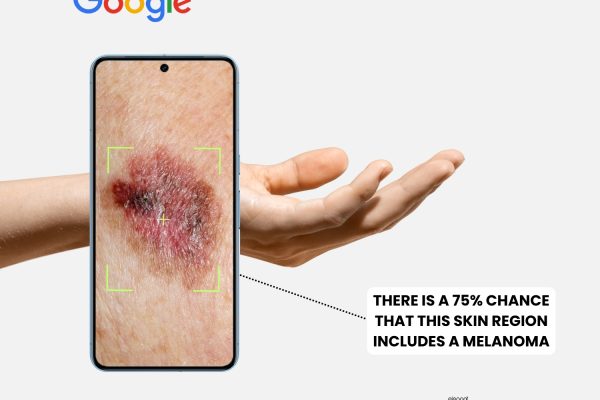 Your Smartphone Can Turn into Skin Cancer Diagnostic Tool, Thanks to 3D Ultrasonic Sensor