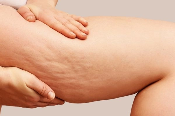 What is Cellulite?
