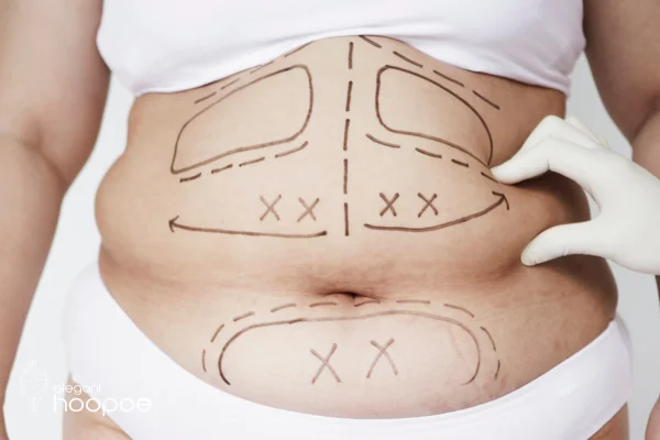 Is liposuction dangerous?