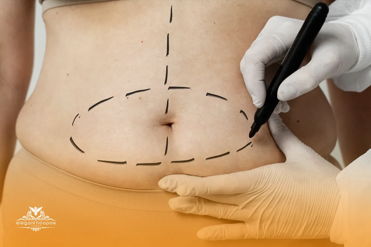 A clinician marking a patient’s abdomen with dotted lines to outline treatment zones for non-invasive fat removal in Dubai