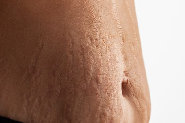 Stretch Marks Treatments: Top Medical & Home Remedies