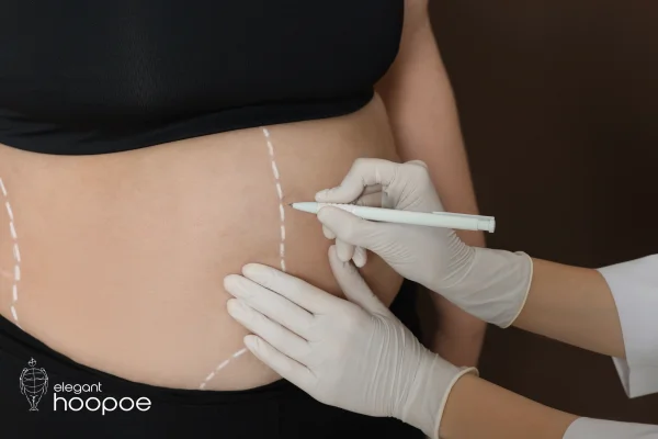 360 Liposuction in Dubai & Abu Dhabi