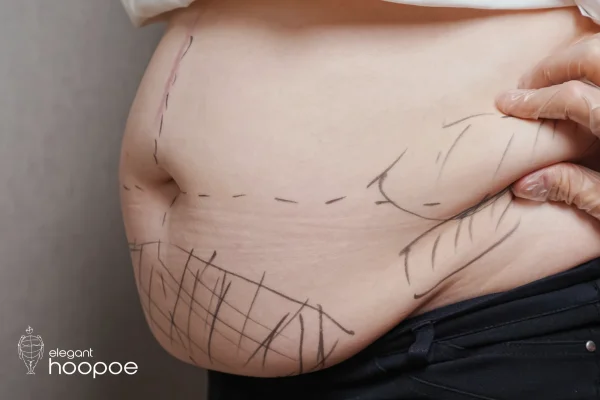 What is 360 Liposuction?