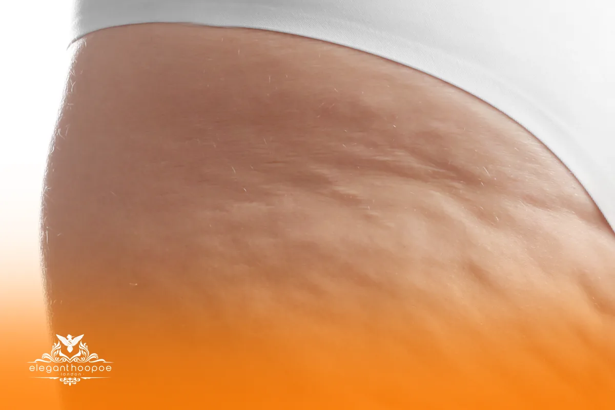 Close-up of a woman’s upper thigh showing visible cellulite dimples and uneven skin texture