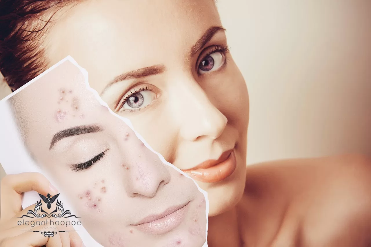 acne scar treatment dubai