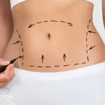 How much weight do you lose with liposuction in Dubai?