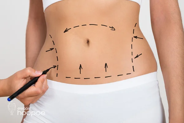 How much weight do you lose with liposuction in Dubai?