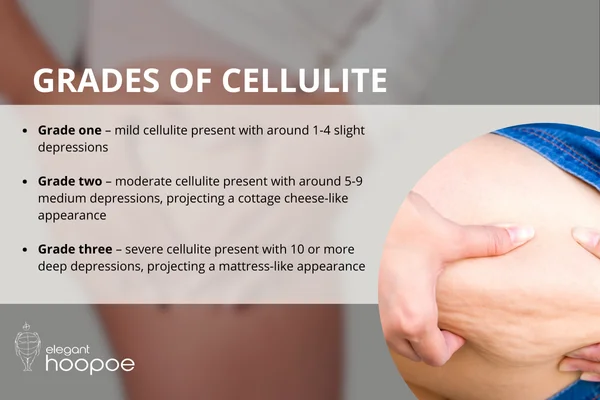 Grades of cellulite