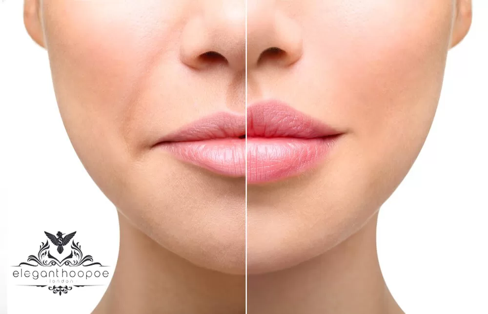 lip fillers in UAE