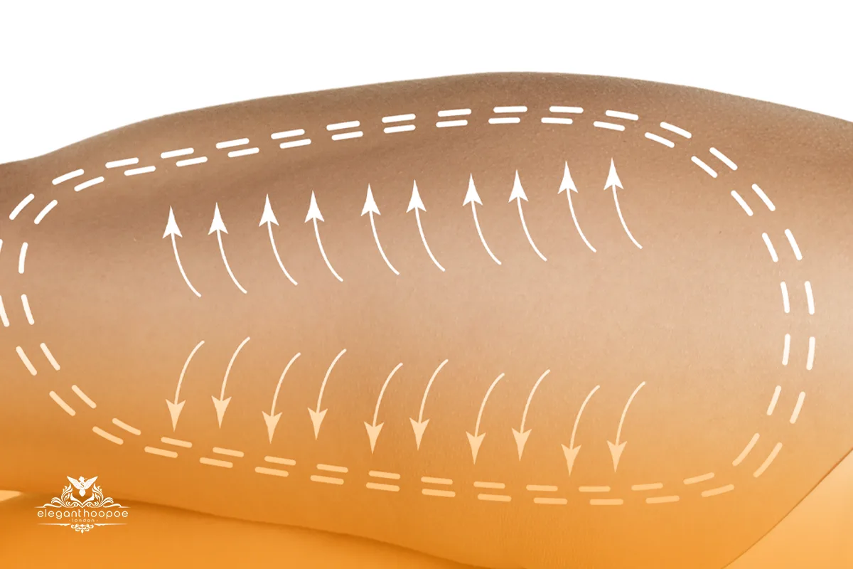 Illustration of skin layers with arrows showing the action path of radiofrequency and ultrasound waves breaking down fat cells