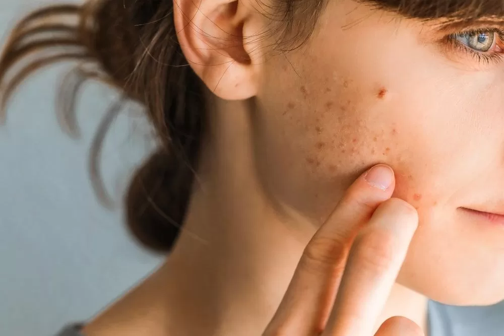 inflammatory acne dubai