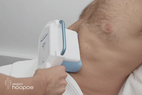 Is coolsculpting safe?