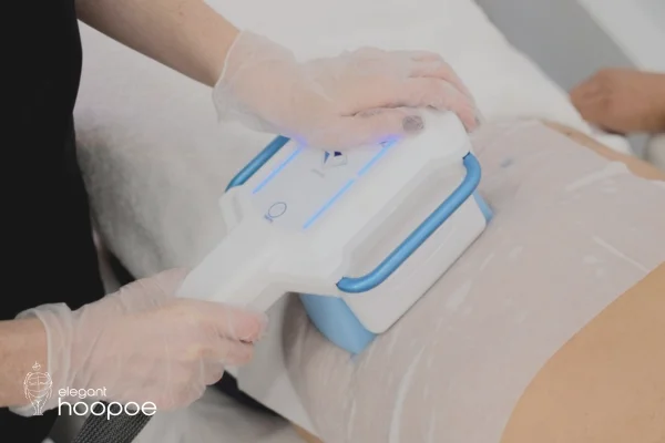 What is coolsculpting?