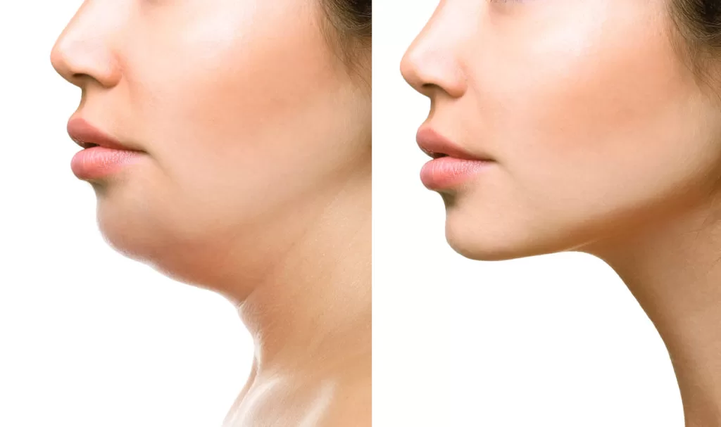 Double Chin Treatment Dubai Before and After