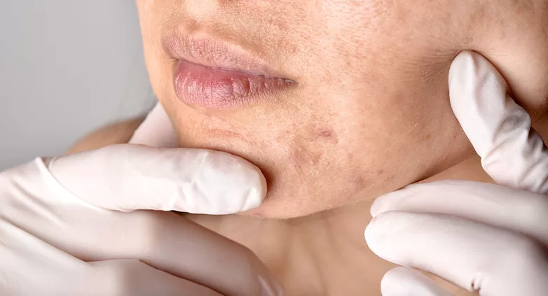 INFLAMMATORY ACNE