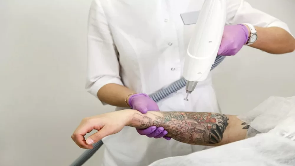 tattoo removal laser