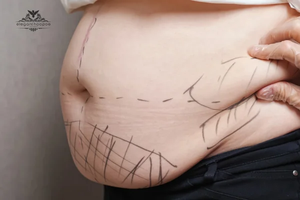 Effects of Liposuction on Self-Perception and Overall Well-Being