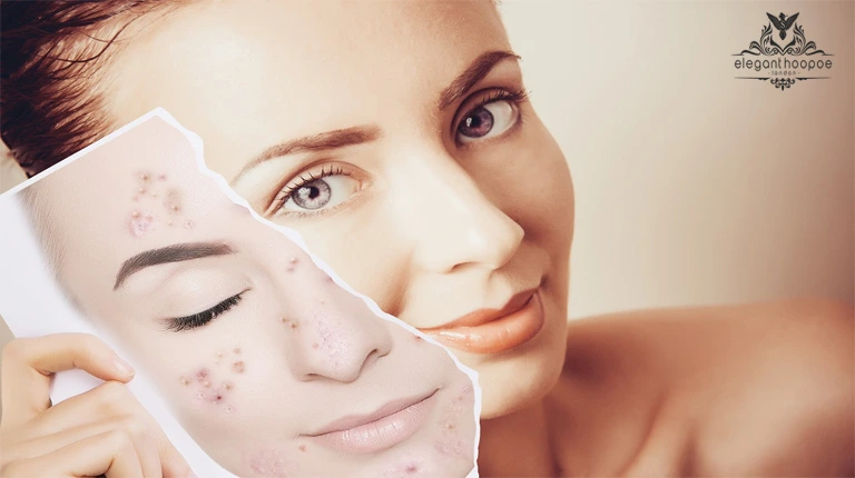 acne scar removal