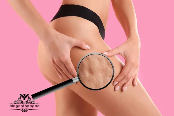 Top 5 Cellulite Reduction Technologies for Smooth, Firm Skin: What’s New?