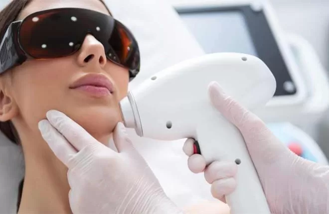 laser facial hair removal