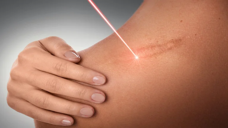 laser stretch marks removal