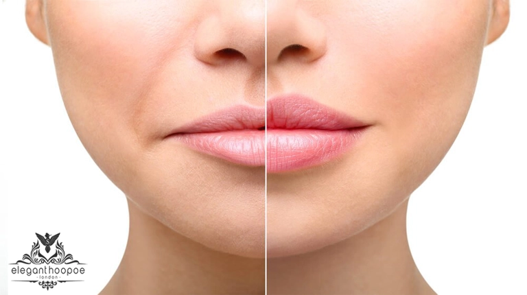 lip fillers