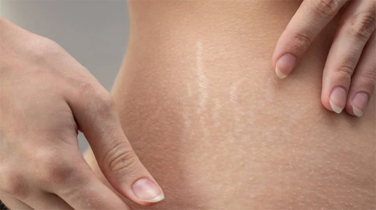 stretch marks in dubai