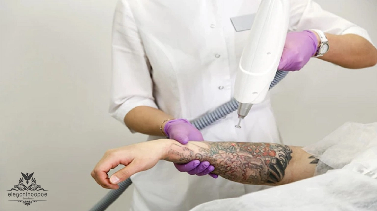 tattoo removal laser