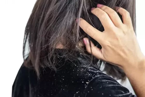 Itchy Scalp? Say Goodbye to Dandruff with These ...