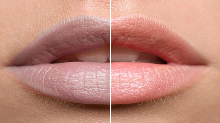 lip pigmentation