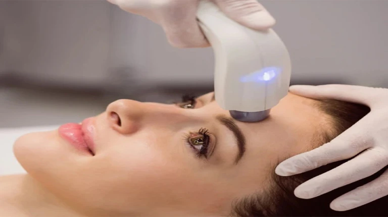 melasma laser