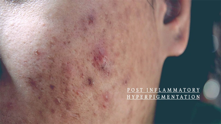 Hyperpigmentation