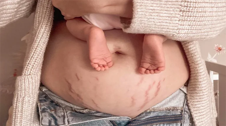 pregnancy stretch mark