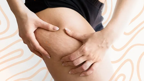 Close-up of a person's thigh being pinched by both hands, revealing the appearance of cellulite