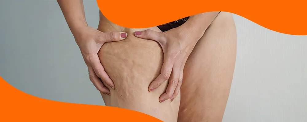 Woman's thigh showing cellulite dimpling