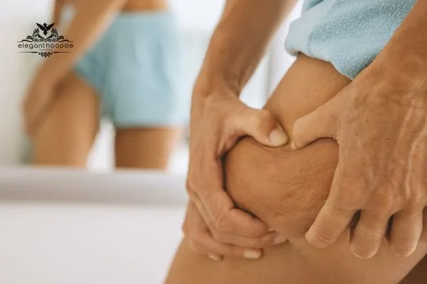 Close-up of a person pinching thigh skin to expose the dimpled texture of cellulite