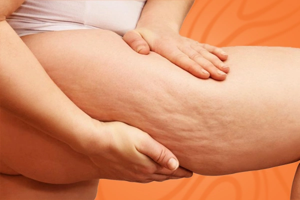 Why Cellulite Affects Skinny People Too? Factors That Matter!