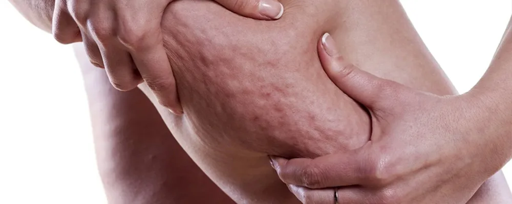 Close-up of a person pinching thigh skin to expose the dimpled texture of cellulite