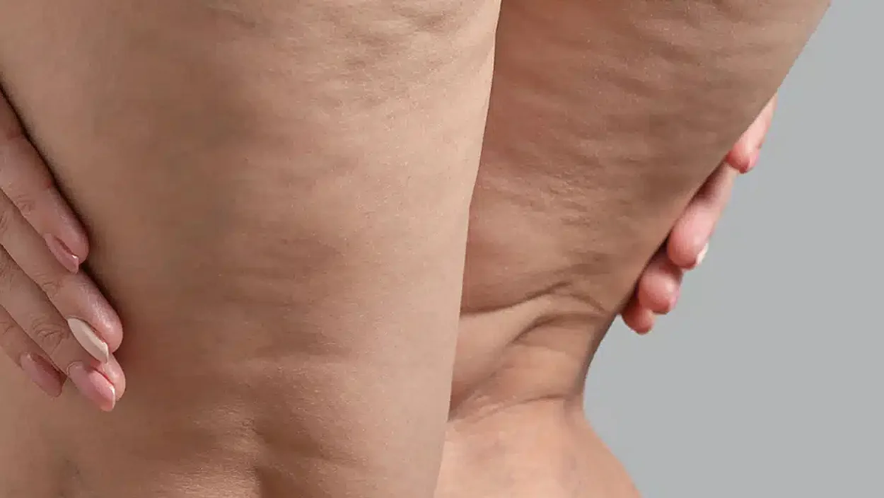 Close-up of dimpled skin texture (cellulite) on the abdomen and on the sides