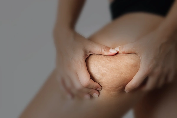 Woman examining leg dimples prior to following tips to reduce cellulite in two weeks