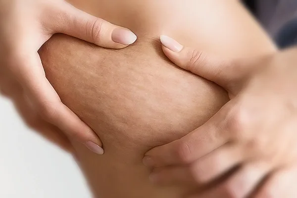 8 Best Cellulite Treatments in 2025 | Clinical & At-Home Options